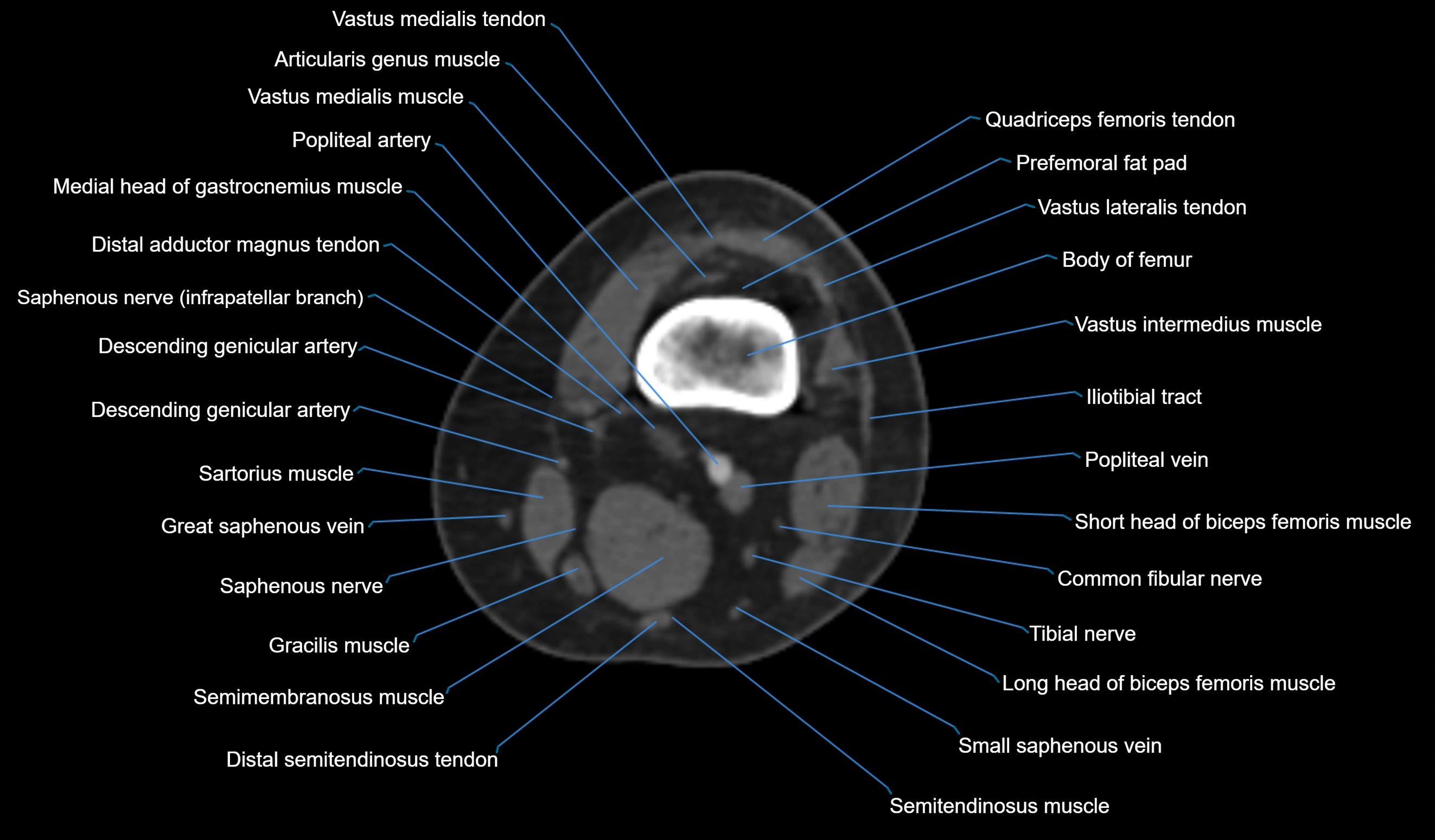 CT knee axial cross sectional anatomy labelled image-00015.webp